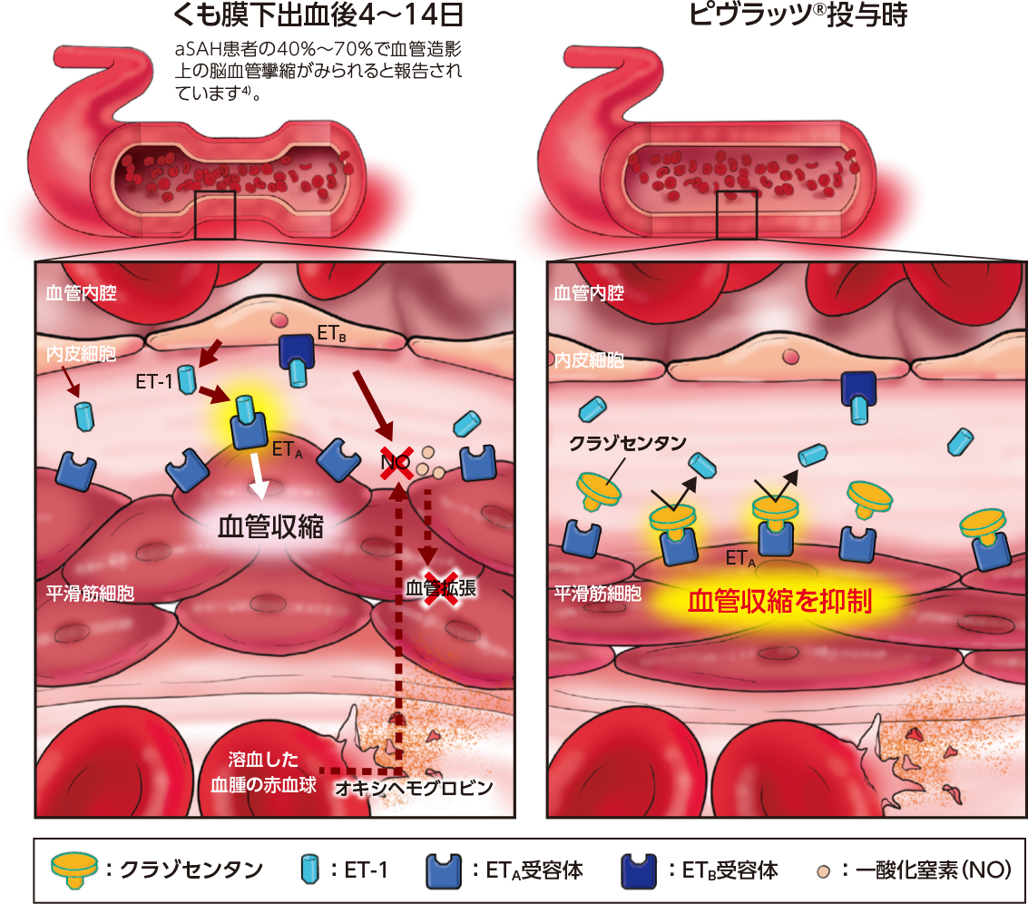 くも膜下出血後4~14日 ピブラッツ投与時
